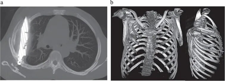 کشف عجیب در قفسه سینه؛ چاقویی که ۸ سال در بدن مردی جا خوش کرده بود/ عکس