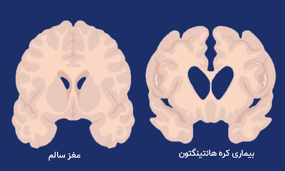 درمان موفقیتآمیز یک بیماری سخت برای اولین بار