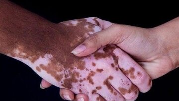 روشی برای کاهش لکهای پوستی در ایران روشی برای کاهش لکهای پوستی در ایران