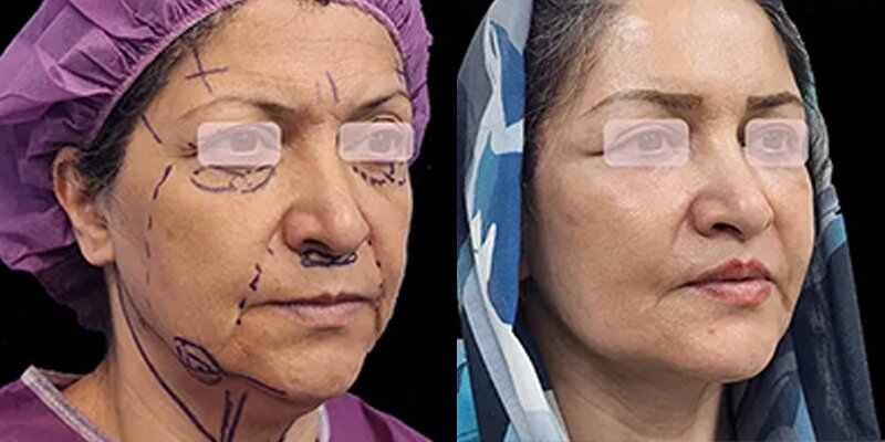 لیفت صورت کامل