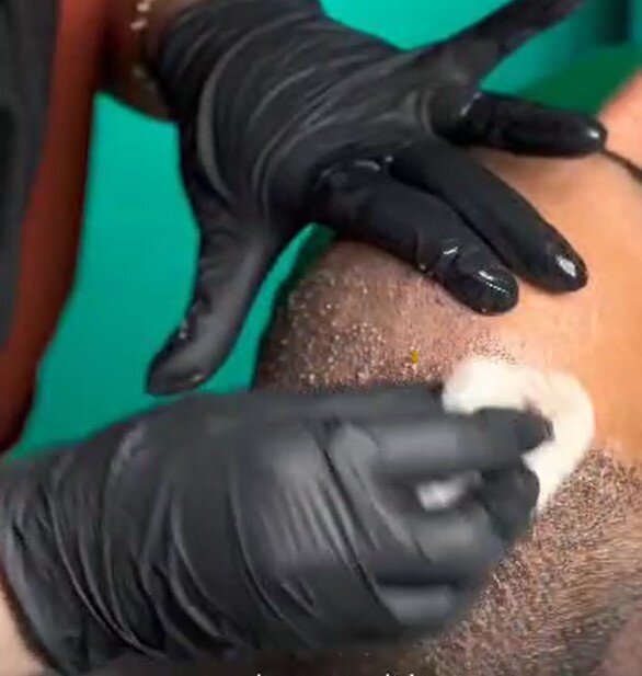 مراقبت_های بعد از کاشت مو_ شست_وشوی ملایم