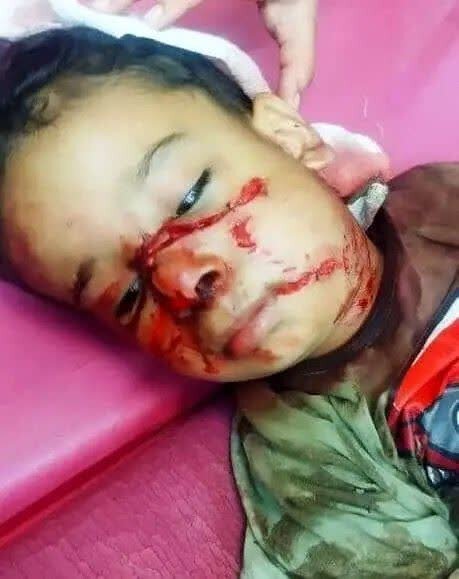 حمله سگهای بدونصاحب به کودک ۴ ساله/ عکس دلخراش