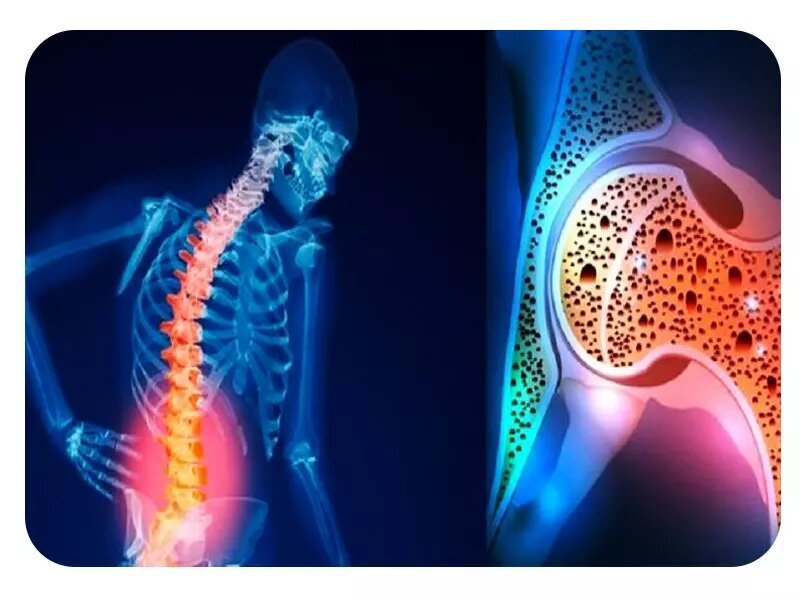 برای افزایش تراکم استخوان چه بخوریم؟/ نمونه برنامه غذایی روزانه مبتلایان به استئوپنی/ ورزش‌های مناسب تراکم استخوان 