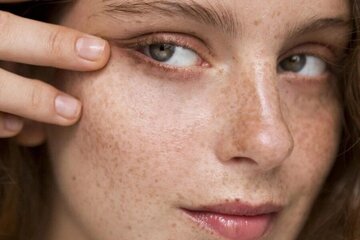 آشنایی با انواع لکهای پوستی آشنایی با انواع لکهای پوستی