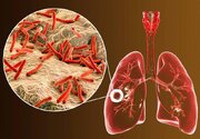 ابتلای ۶ هزار ایرانی به یک بیماری خطرناک ریوی/ ۸ استان در صدر شیوع بیماری