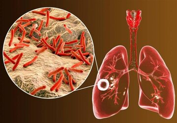 ابتلای 6 هزار ایرانی به یک بیماری خطرناک ریوی / 8 استان در صدر شیوع بیماری