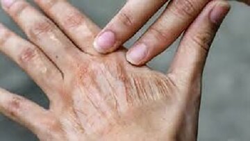 اقدام ساده برای رفع خشکی پوست