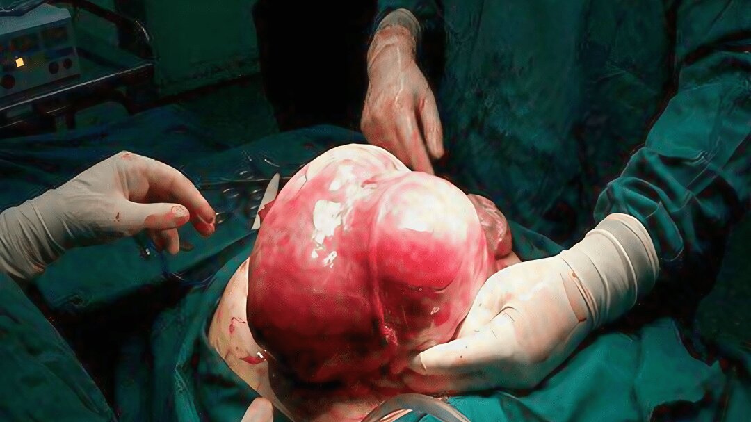 خارج کردن توده ۷ کیلویی از بدن بیمار اردبیلی/ عکس