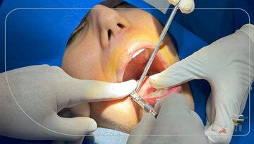 فناوری های به کار برده شده در ایمپلنت دیجیتال ۲۰۲۶