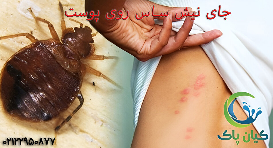 جای نیش ساس روی پوست