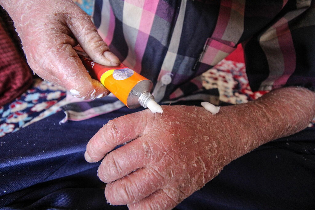 ماجرای رها شدن یک نوزاد پروانهای در بیمارستان