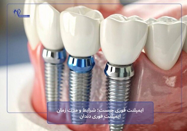 ایمپلنت فوری چیست؛ شرایط و مدت زمان ایمپلنت فوری دندان