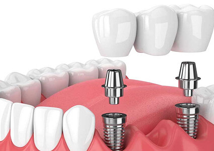 معایب و عوارض ایمپلنت ۱ روزه و فوری چیست؟