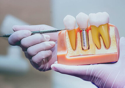 منظور از ایمپلنت فوری دندان چیست؟