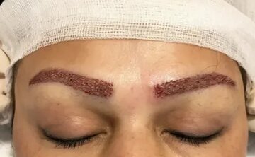 جدیدترین روش کاشت ابرو در تهران