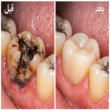 قیمت عصب‌کشی و پرکردن دندان ۱۴۰۴؛ ترمیم، روکش یا کشیدن؟