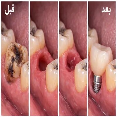 هزینه کشیدن دندان