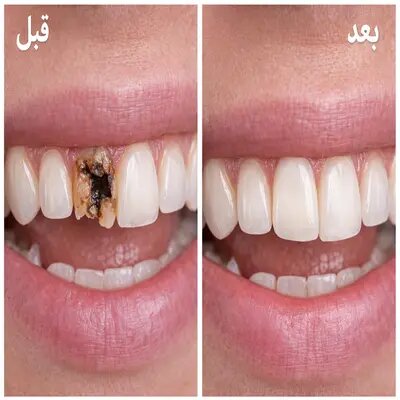 قیمت روکش دندان