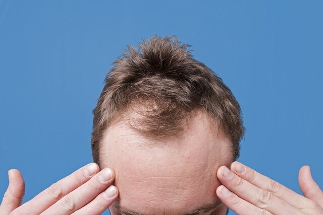 شایعترین نوع ریزش مو در آقایان کدام است؟ شایعترین نوع ریزش مو در آقایان کدام است؟