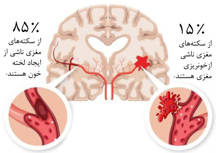 هر آنچه را که باید درباره سکته مغزی بدانید/ دلایل سکته مغزی