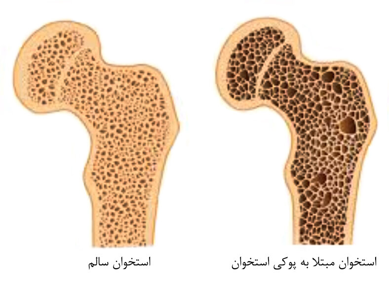 این علائم یعنی استخوانهای شما پوک میشود!