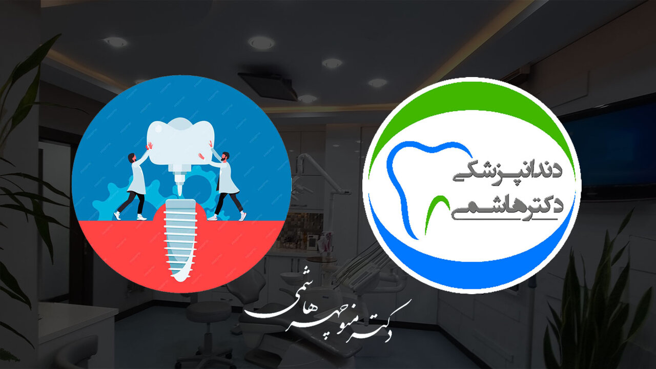 ایمپلنت دندان در تهران