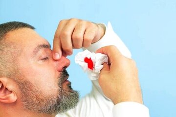 چرا خوندماغ میشویم؟/ شایعترین علل خونریزی بینی چرا خوندماغ میشویم؟/ شایعترین علل خونریزی بینی