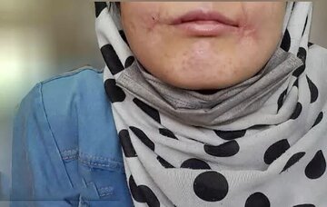 مرد مشهدی لب‌های زن ۱۸ ساله‌اش را دوخت / فائزه به کلانتری پناه برد/ عکس