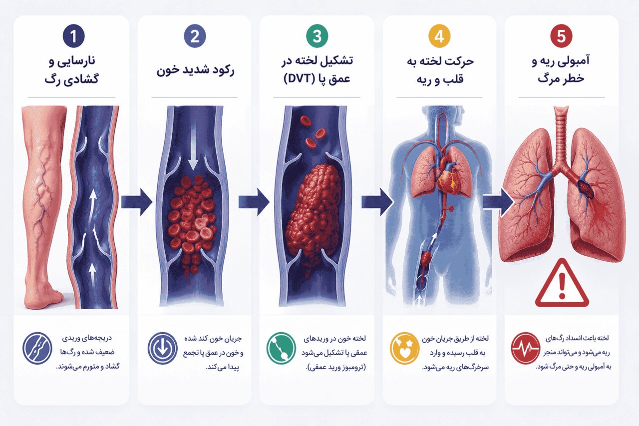 خطرات واریس پا: از زخم های مزمن تا آمبولی ریه