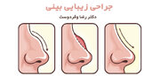 هزینه، راهنمایی و نکات حیاتی جراحی بینی