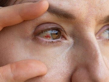 دلایل پارگی رگ خونی در چشم / چه موقع باید به پزشک مراجعه کنیم؟