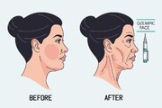 صورت اوزمپیکی؛ از عبارات‌ پرجست‌وجوی حوزه زیبایی